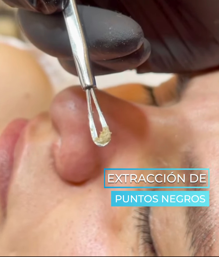 Tratamiento 4